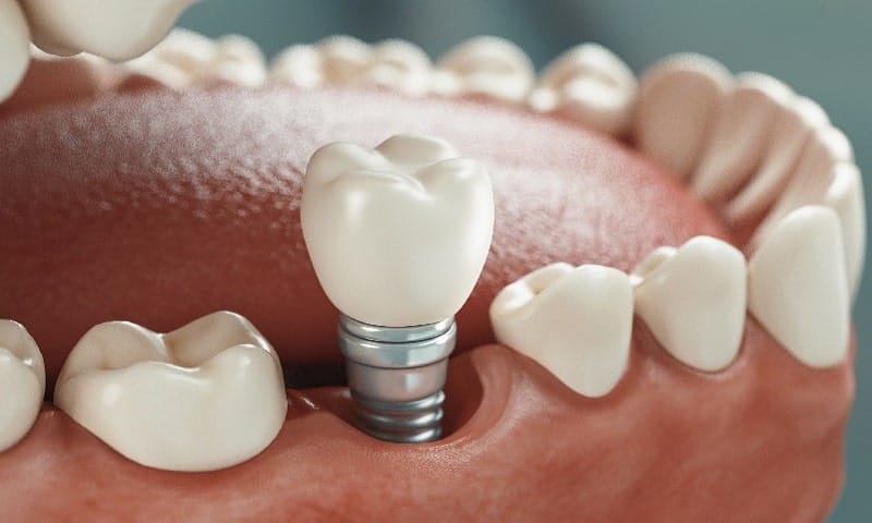 Proceso de un implante dental